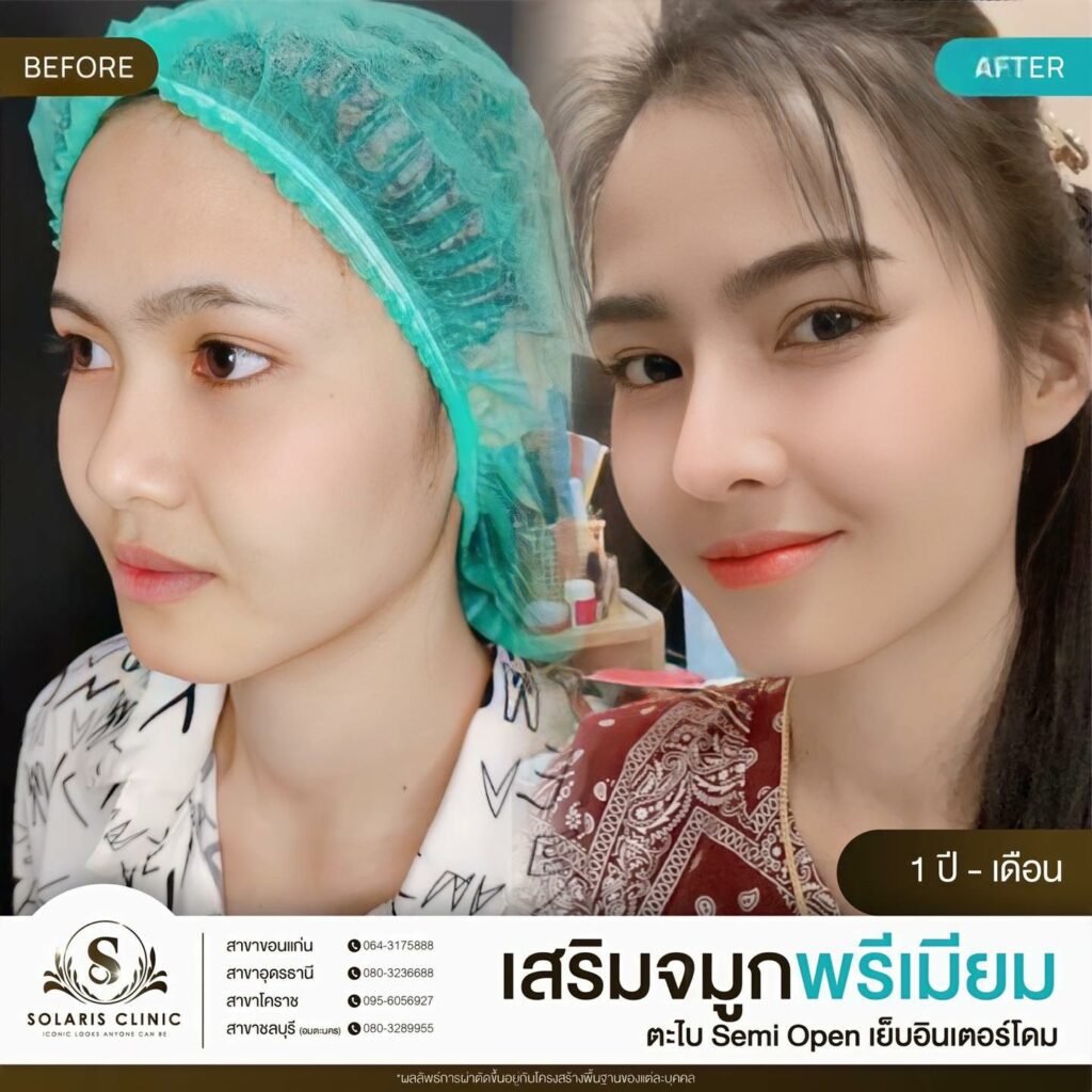 เสริมจมูกอุดร