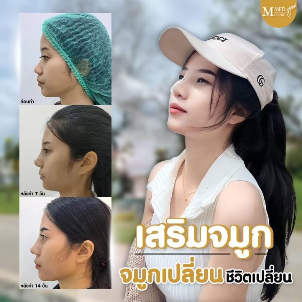 เสริมจมูกอุดร