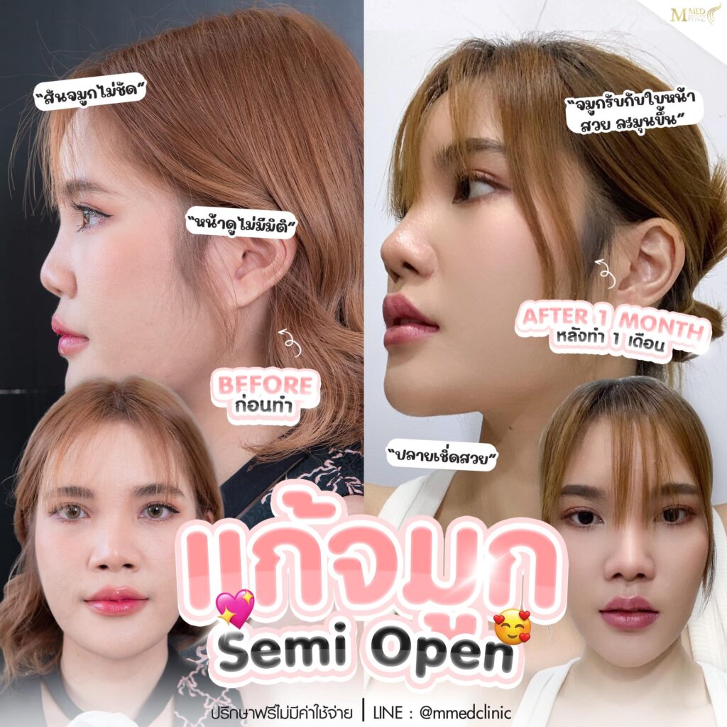 เสริมจมูกอุดร