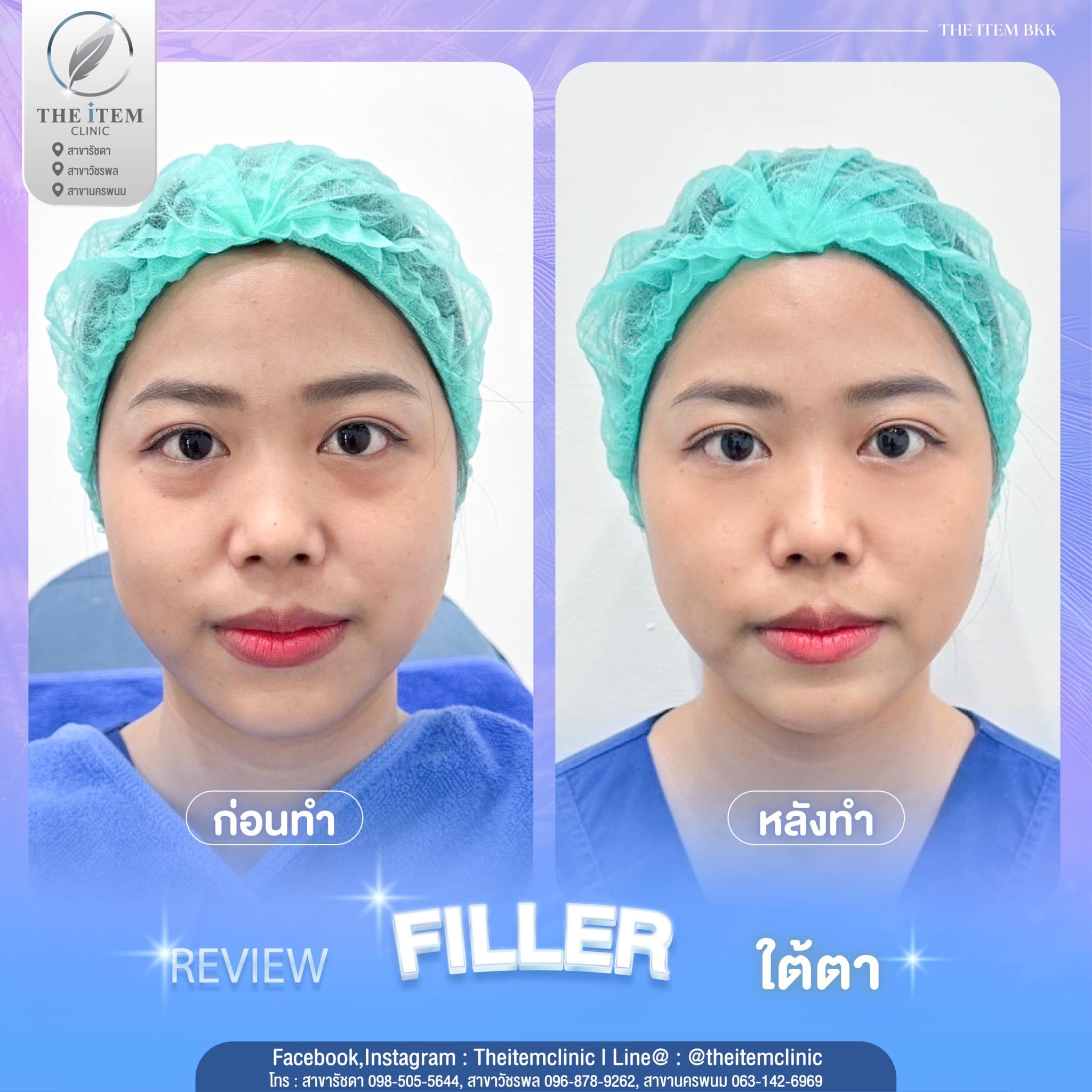 ฟิลเลอร์ นครพนม