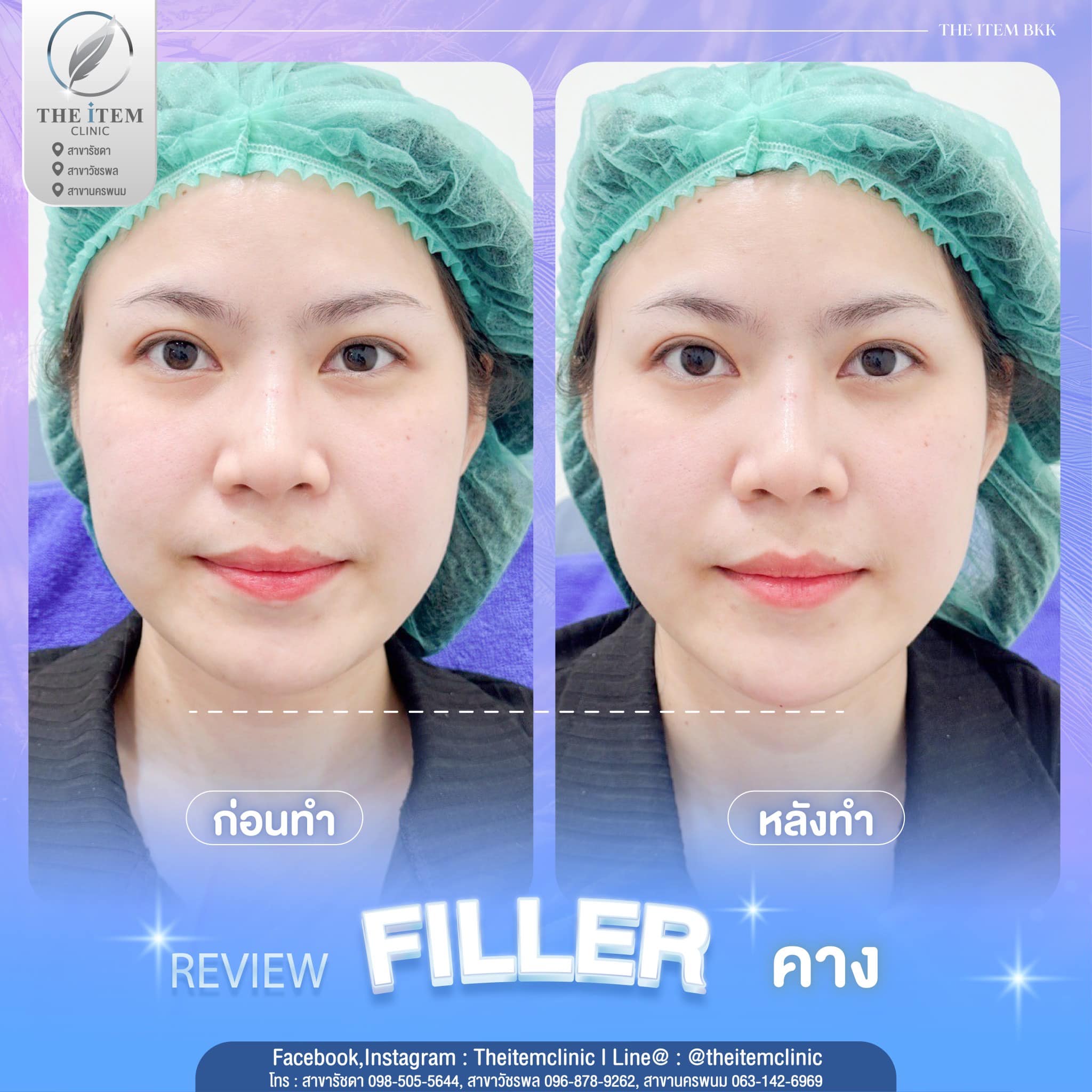 ฟิลเลอร์ นครพนม