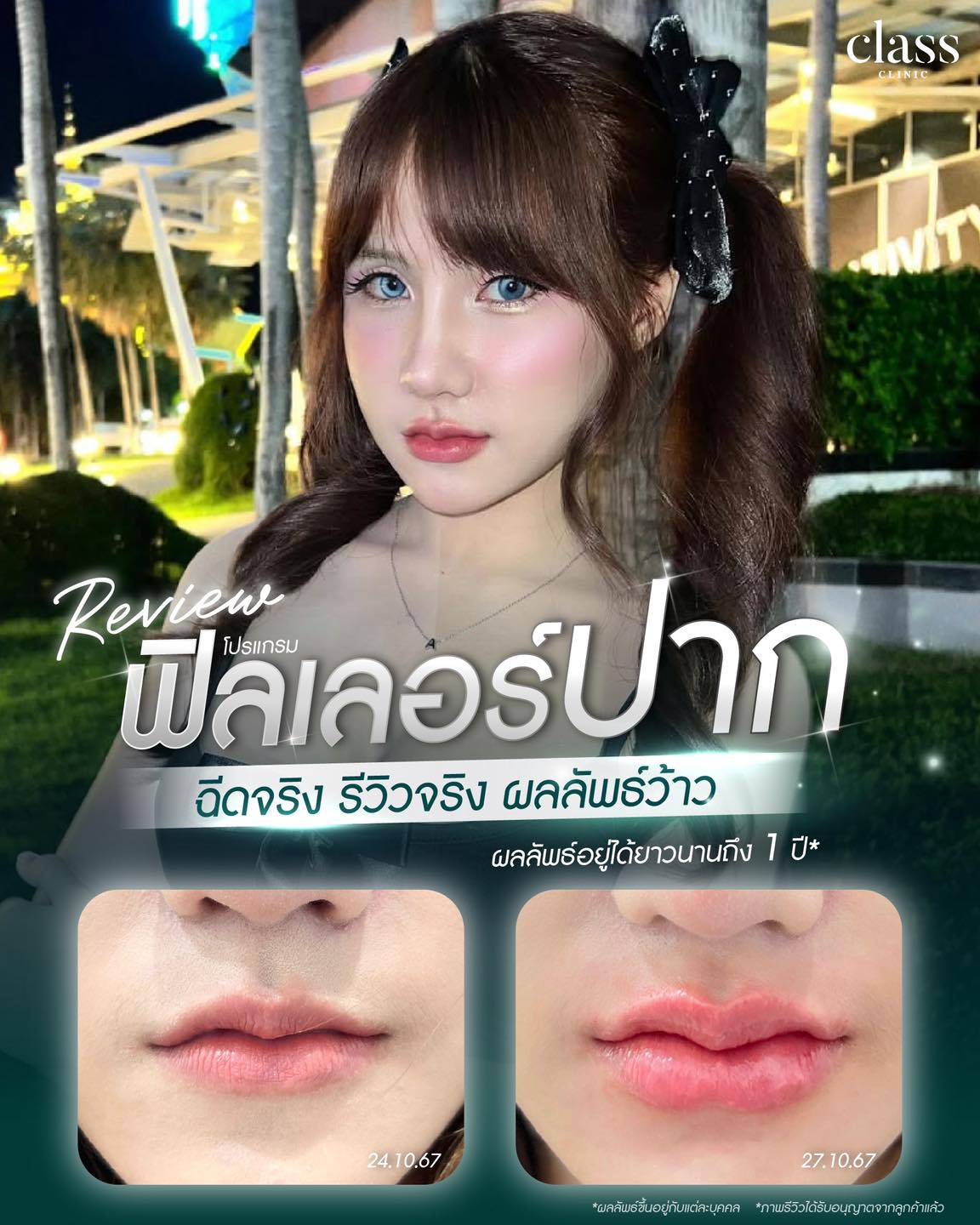 ฟิลเลอร์ นครพนม