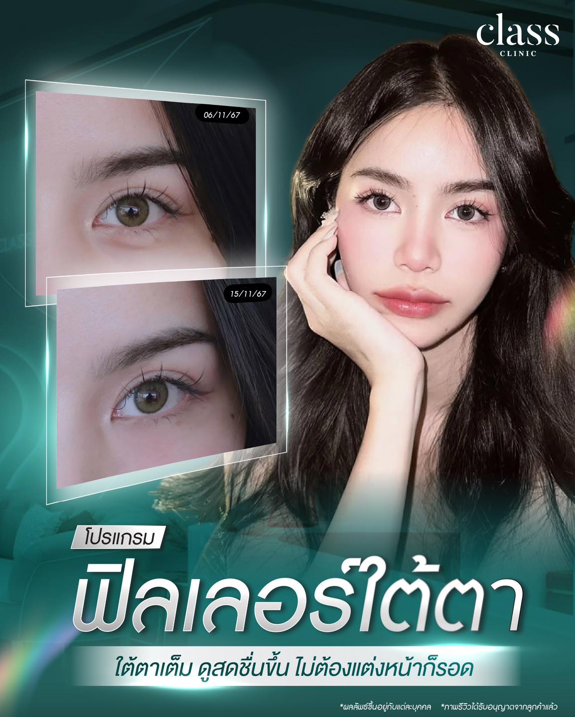 ฟิลเลอร์ นครพนม