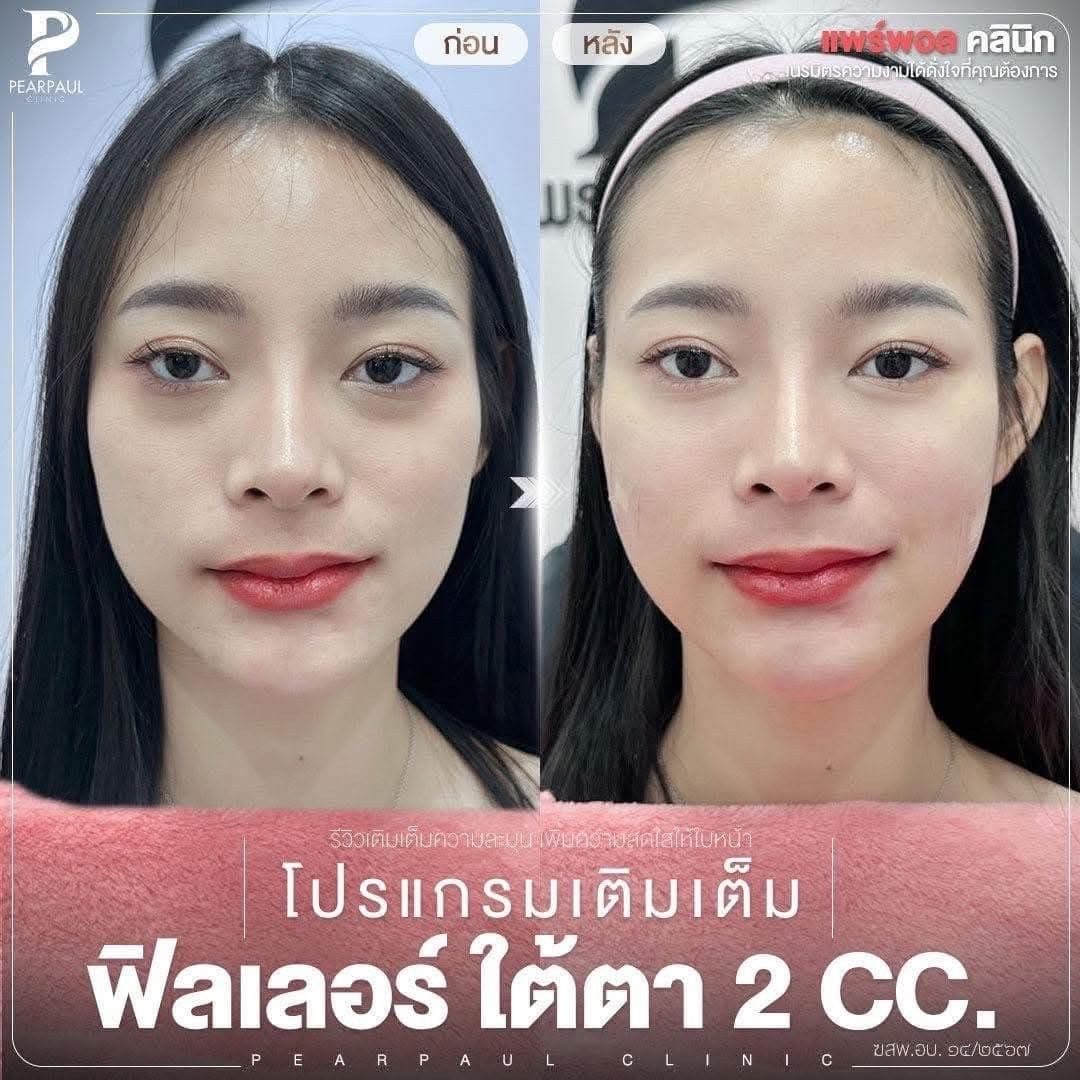 ฟิลเลอร์ นครพนม