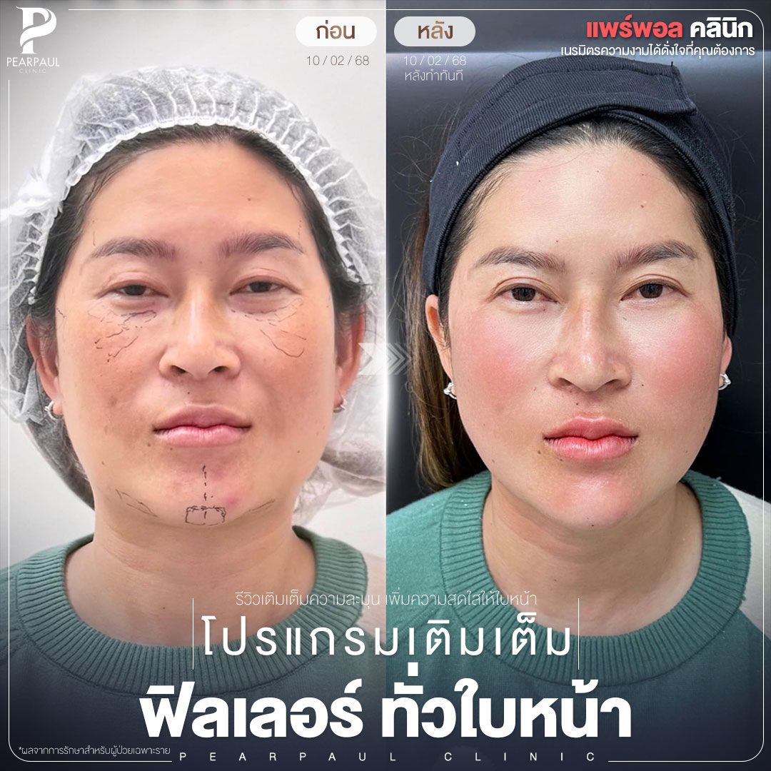 ฟิลเลอร์ นครพนม