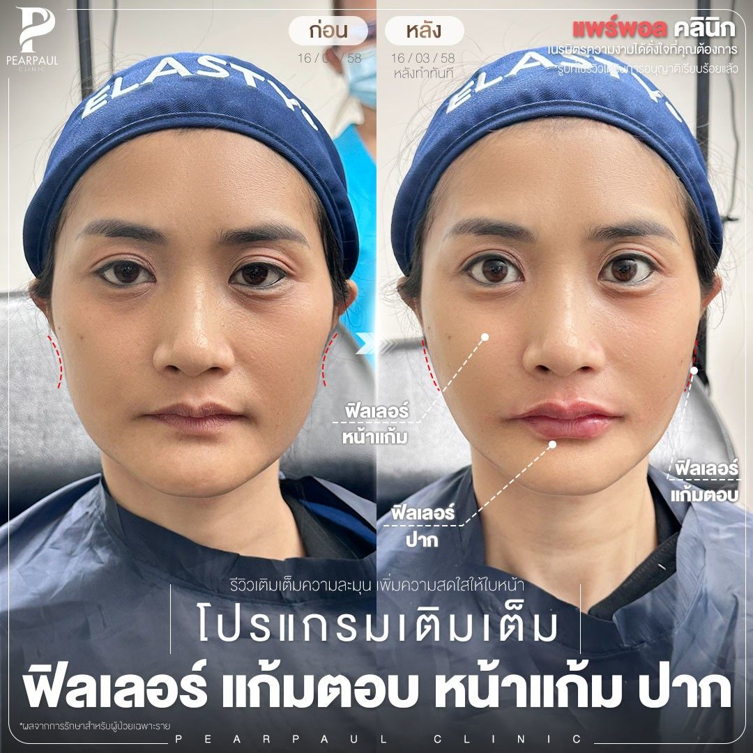 ฟิลเลอร์ นครพนม