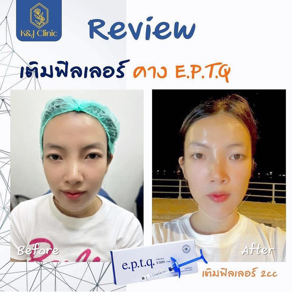 ฟิลเลอร์ นครพนม