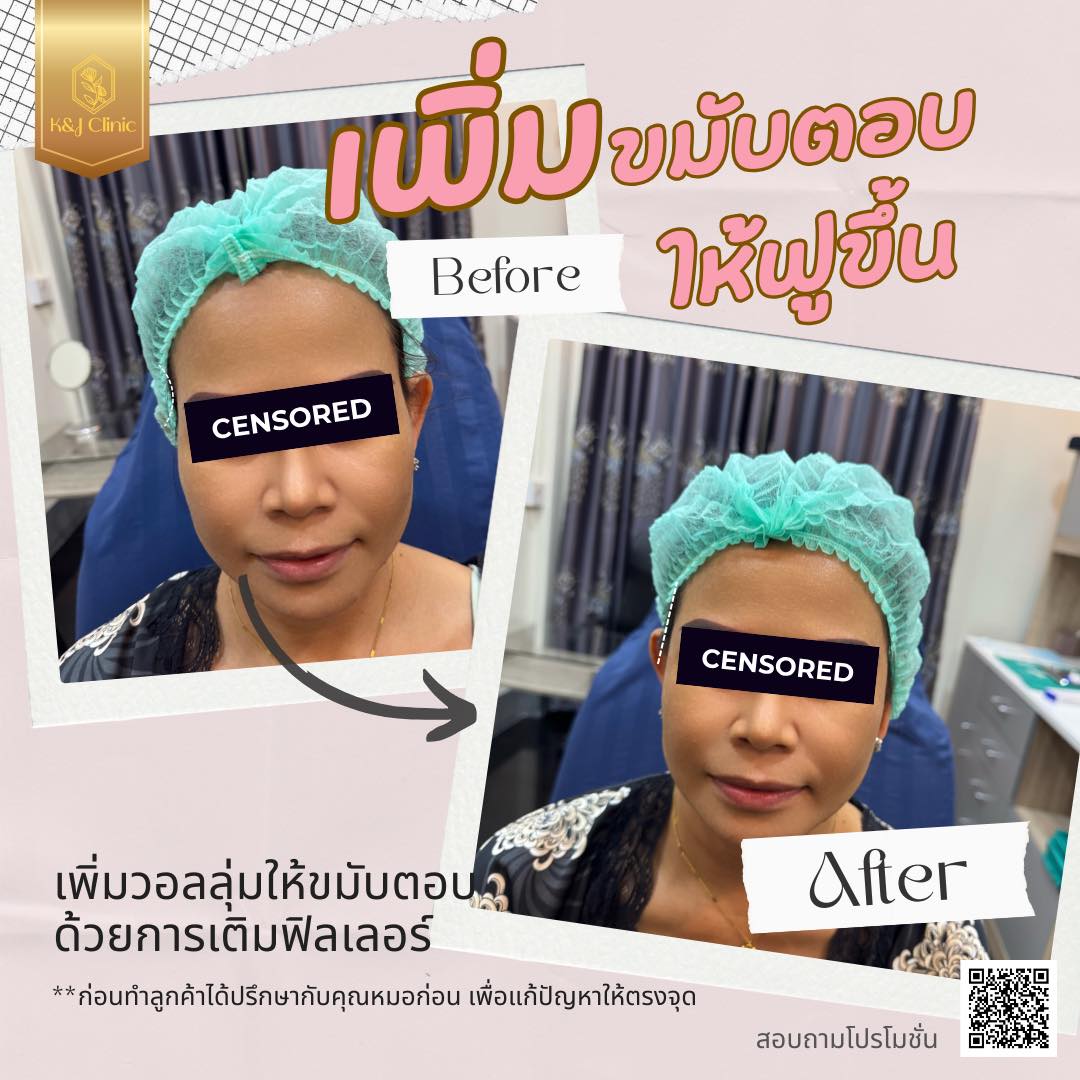 ฟิลเลอร์ นครพนม