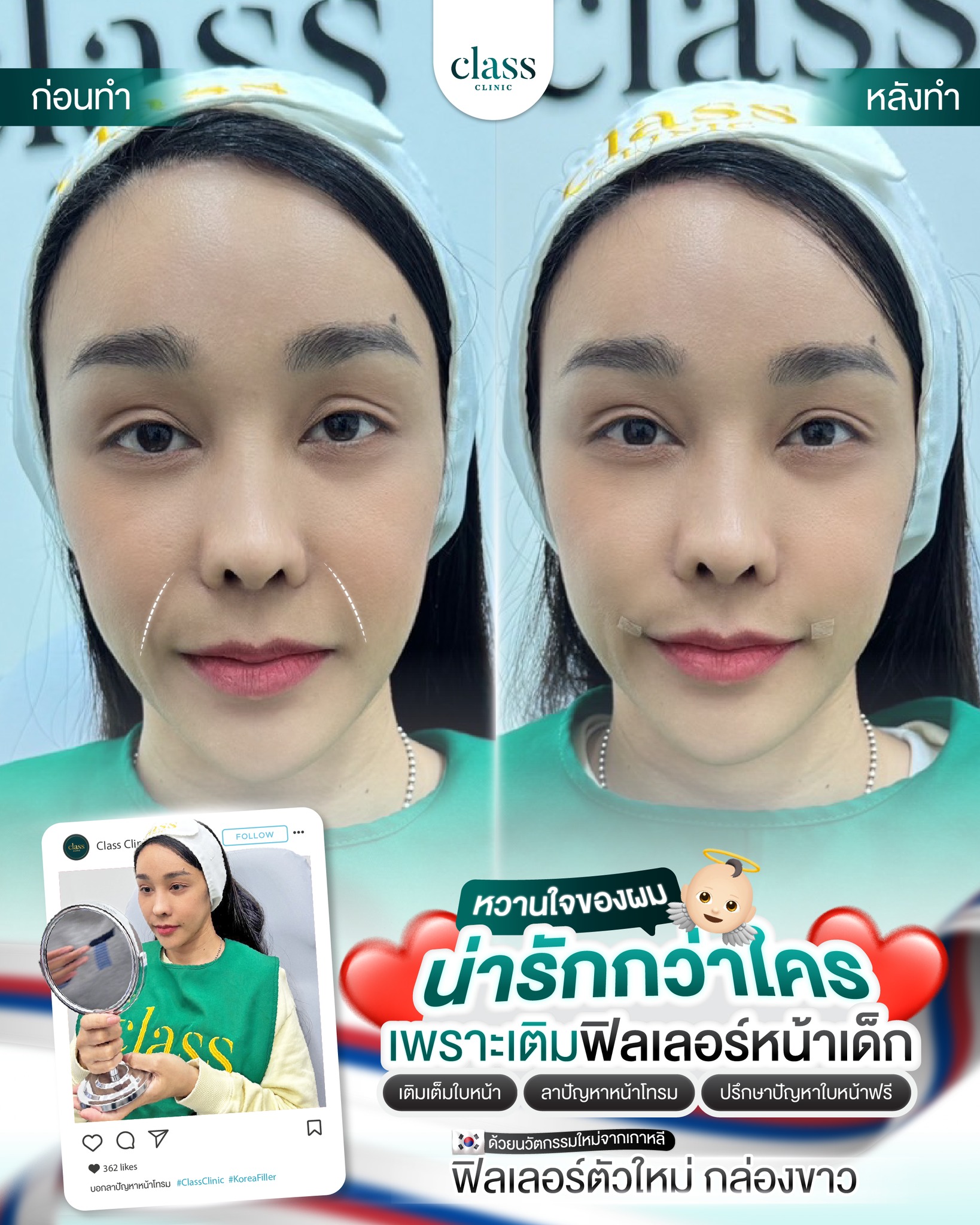 ฟิลเลอร์ นครพนม