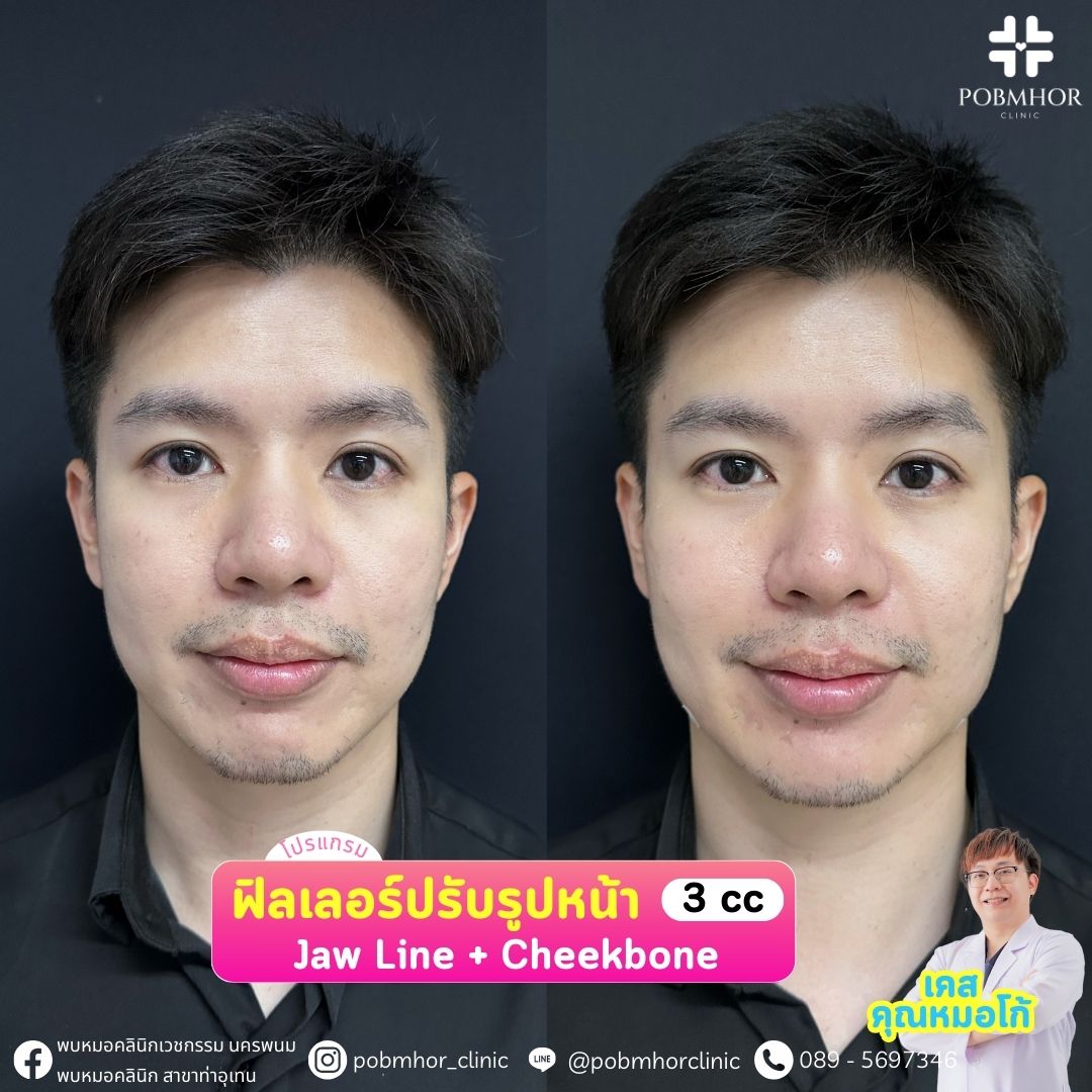 ฟิลเลอร์ นครพนม