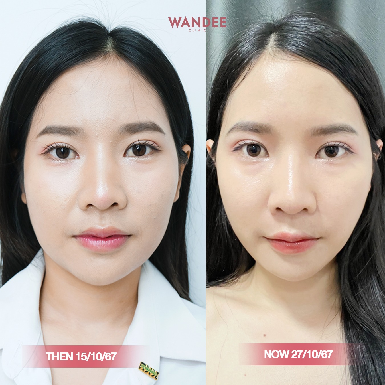 โบท็อกซ์ นครพนม 2025