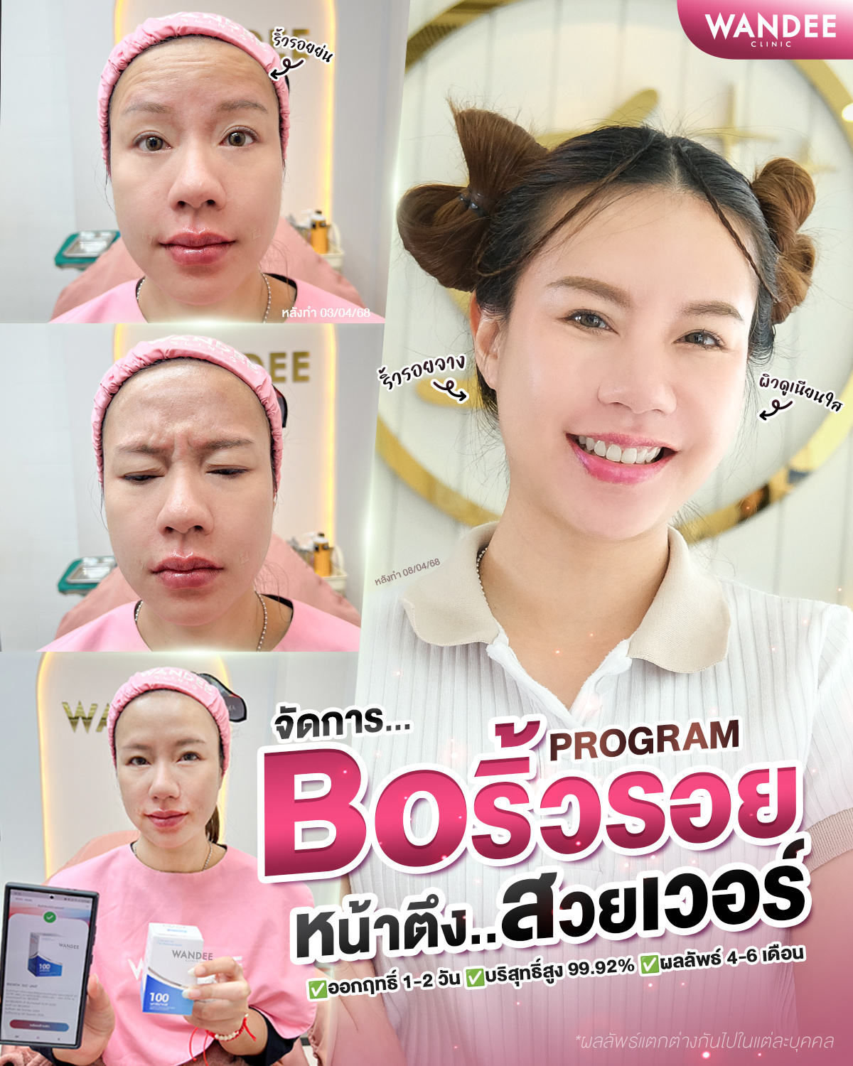 botox