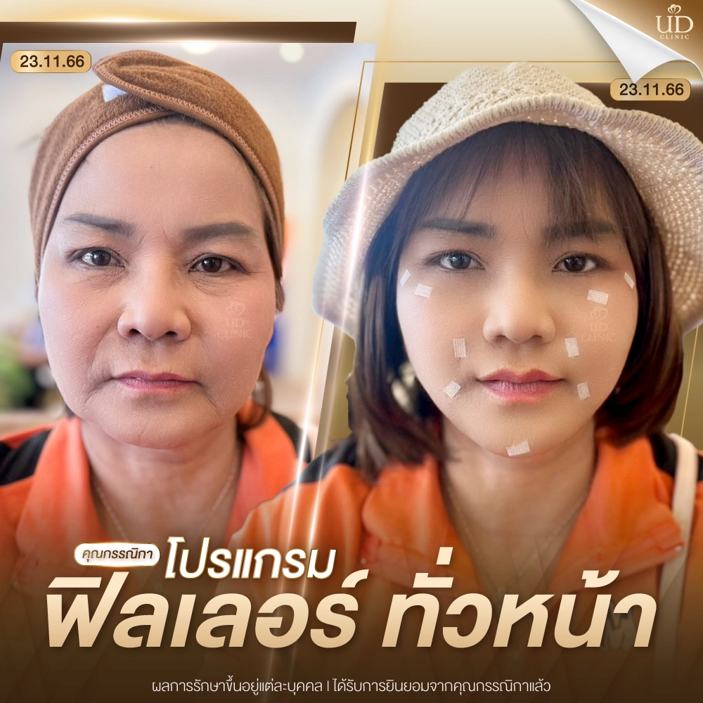 WEB-คุณกรรณิกา-ฟิลเลอร์-UD
