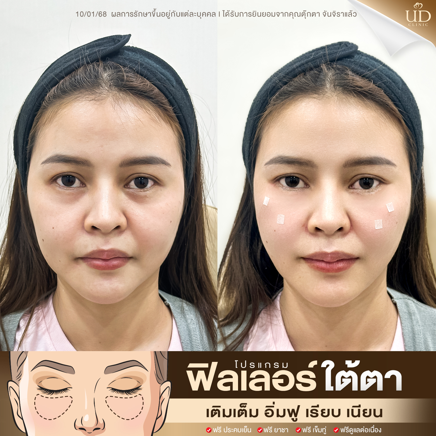 ฟิลเลอร์ud