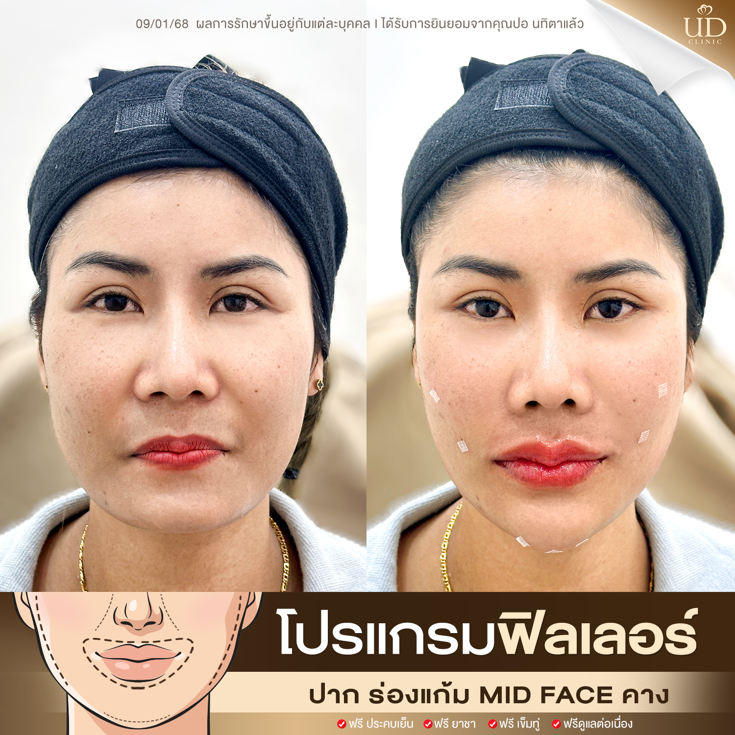 ฟิลเลอร์ud