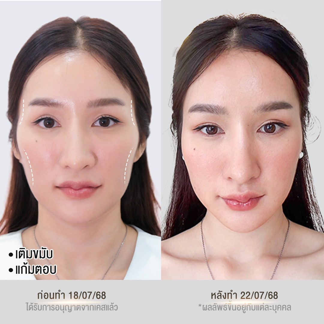 รีวิวฟิลเลอร์