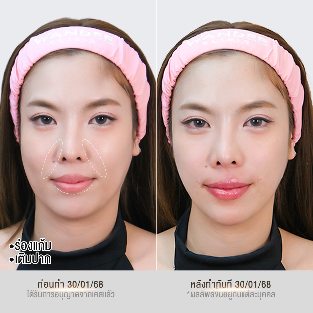 รีวิวฟิลเลอร์