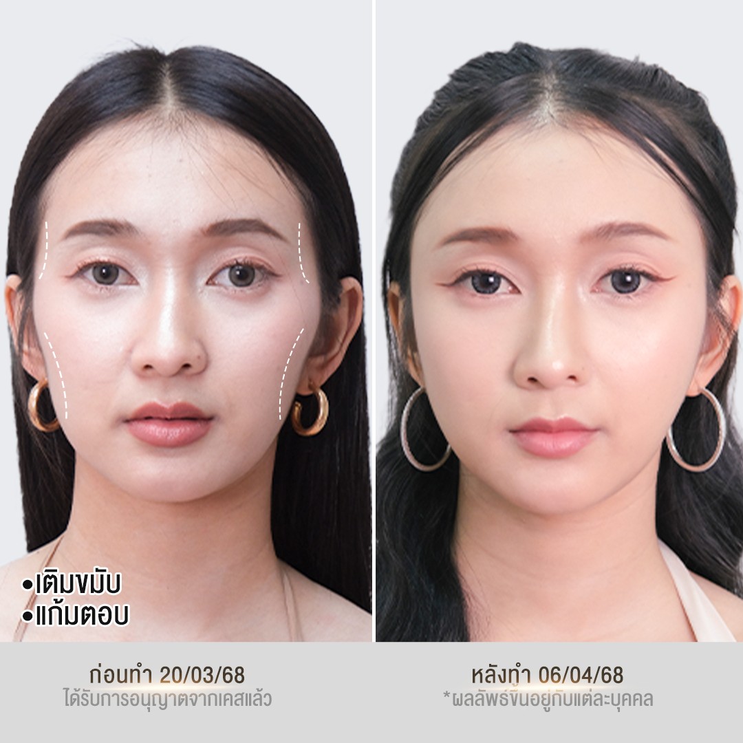 รีวิวฟิลเลอร์