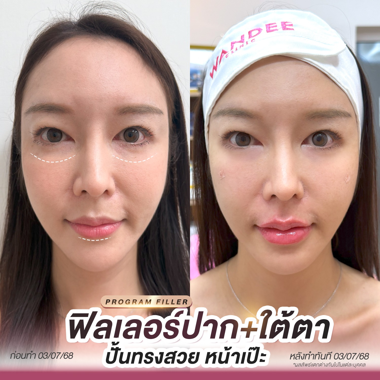 รีวิวฟิลเลอร์ วันดีคลินิก