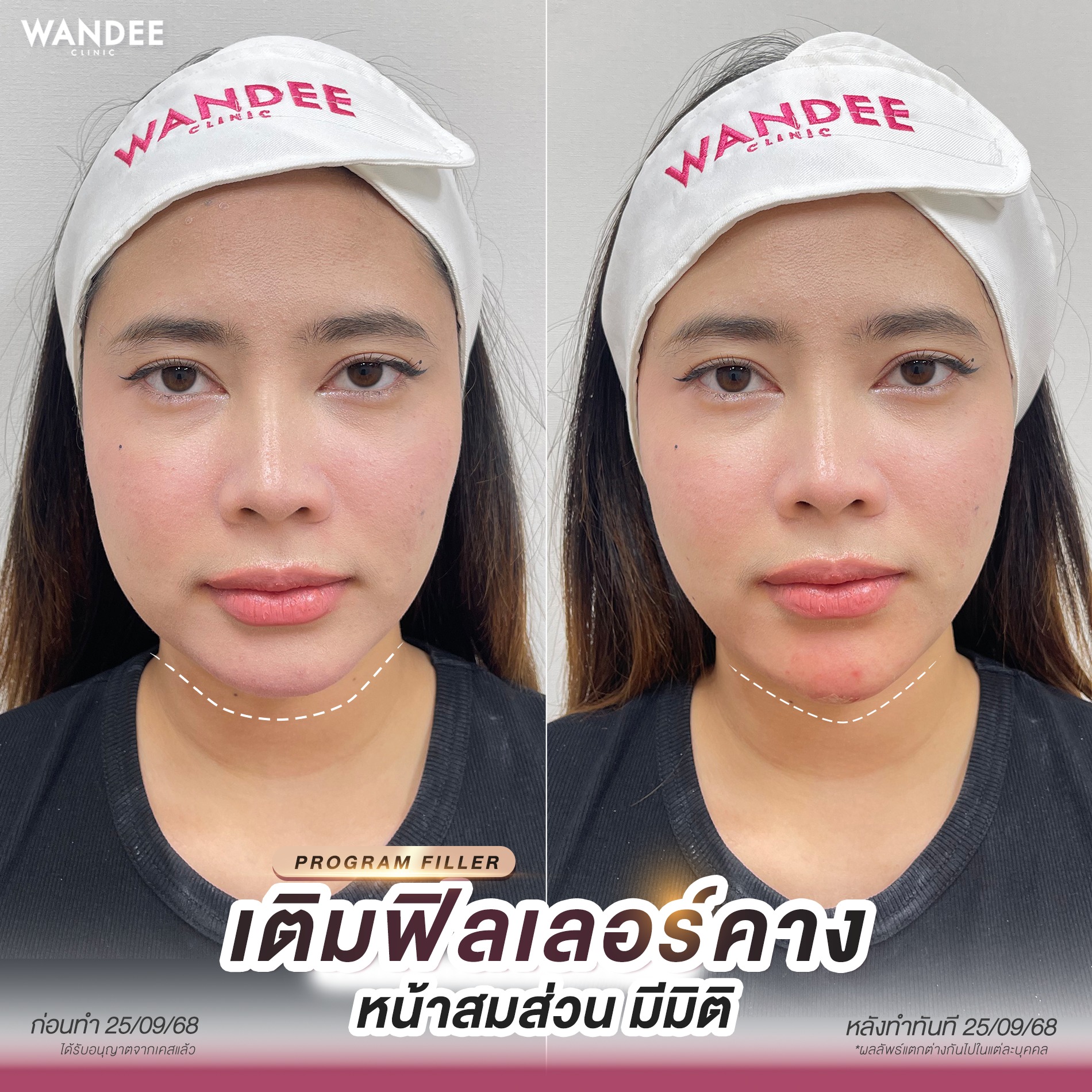 รีวิวฟิลเลอร์ วันดีคลินิก