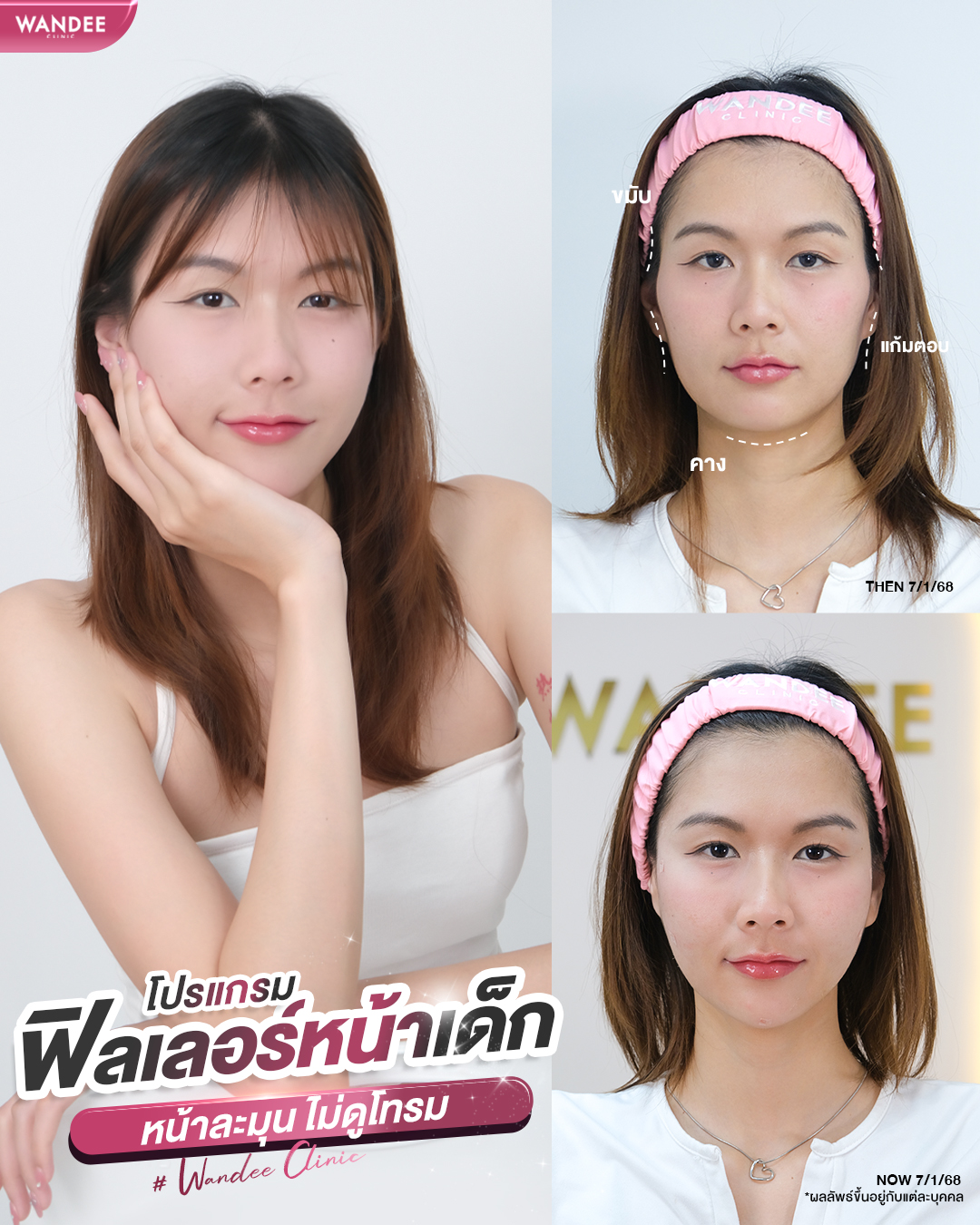 รีวิวฟิลเลอร์