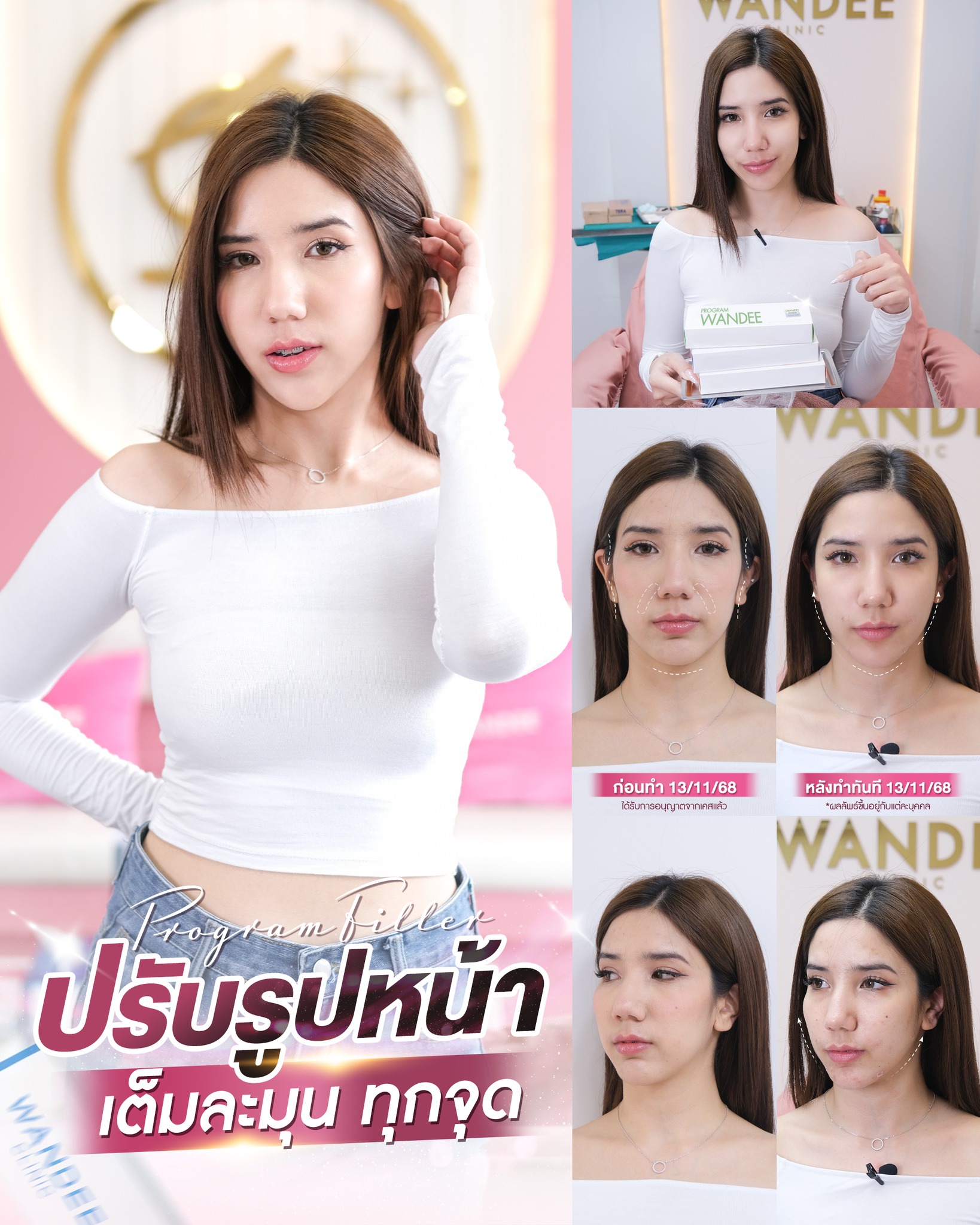 รีวิวฟิลเลอร์