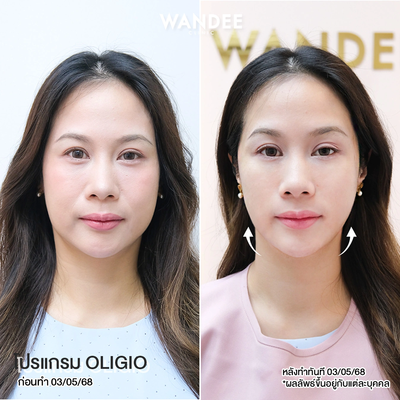 รีวิว แนะนำ 5 คลินิก Oligio ขอนแก่น ที่ได้รับมาตรฐานและความนิยม