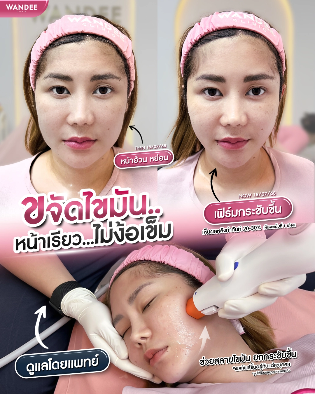 แนะนำ 5 คลินิก Oligio ขอนแก่น ที่ได้รับมาตรฐานและความนิยม