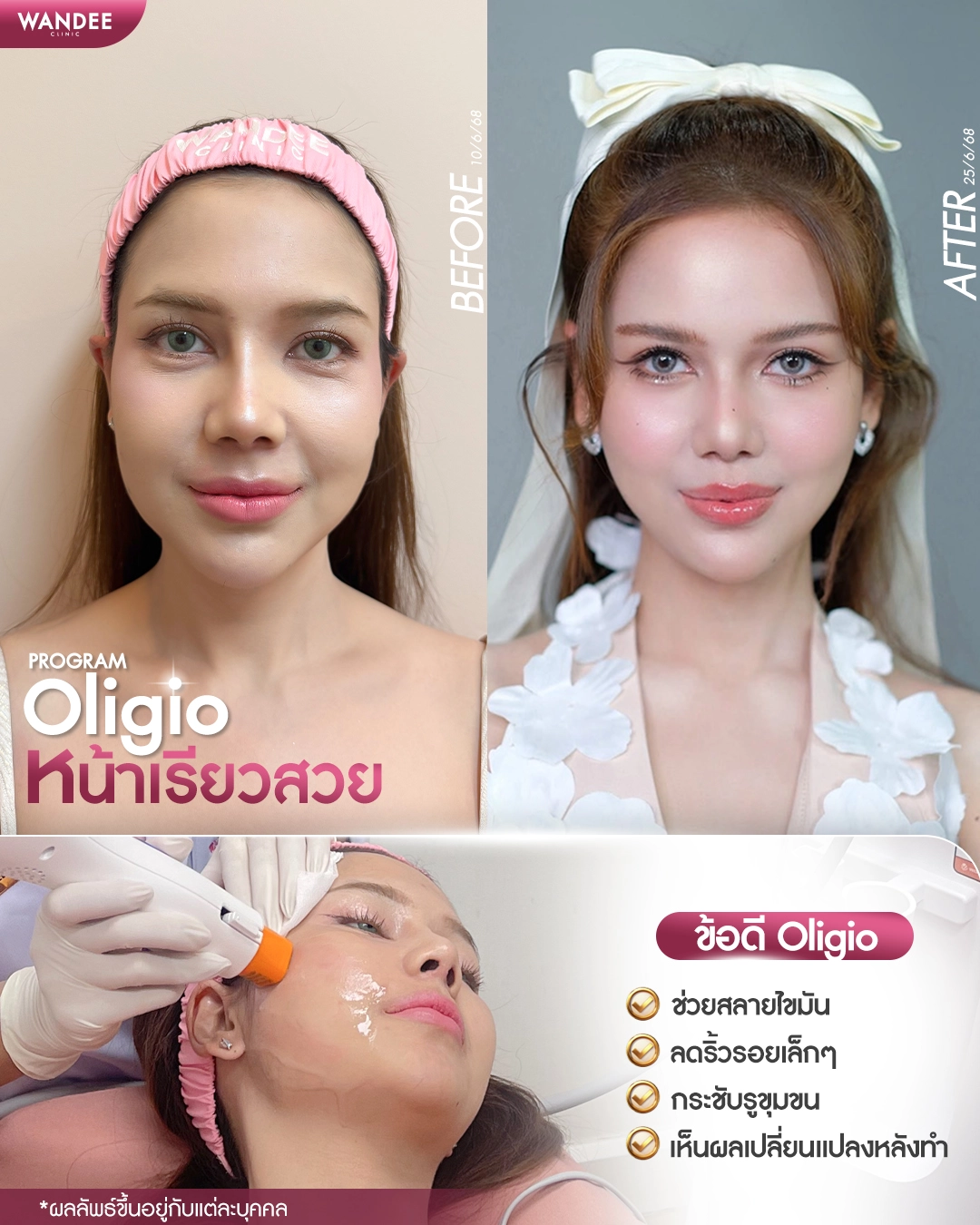 แนะนำ 5 คลินิก Oligio ขอนแก่น ที่ได้รับมาตรฐานและความนิยม