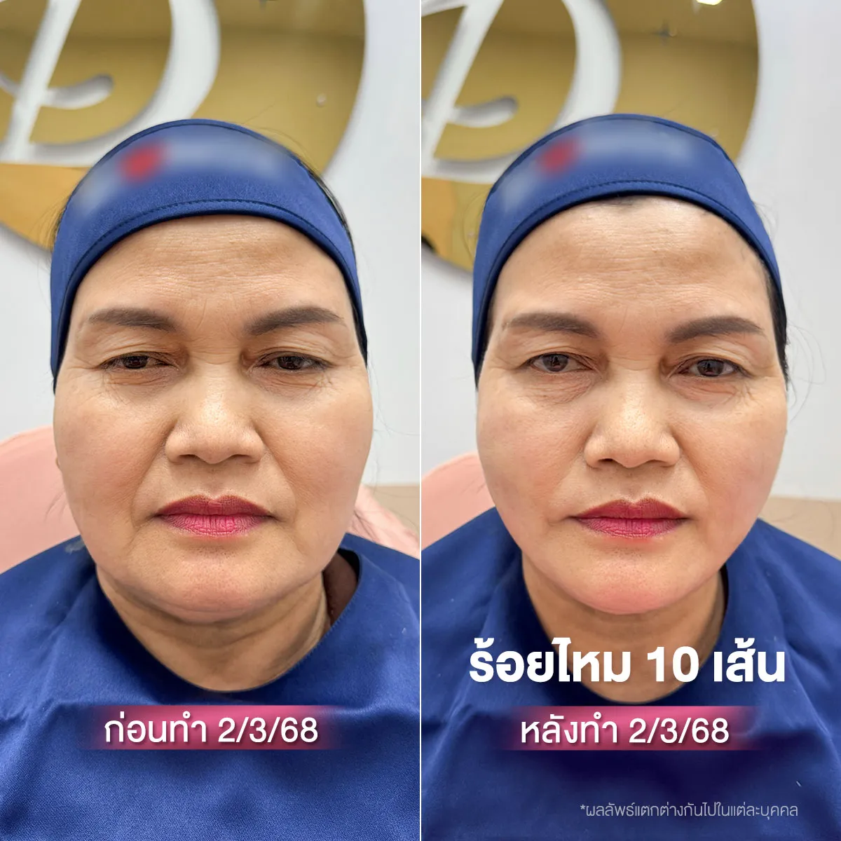 แนะนำ 5 คลินิก ร้อยไหม ขอนแก่น ตึงจริงหรือแค่กระแส