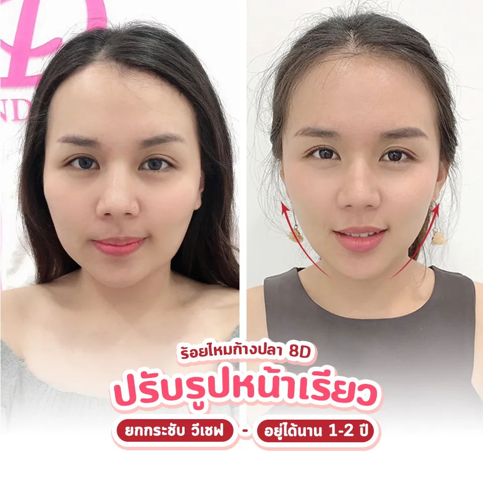 แนะนำ 5 คลินิก ร้อยไหม ขอนแก่น ตึงจริงหรือแค่กระแส