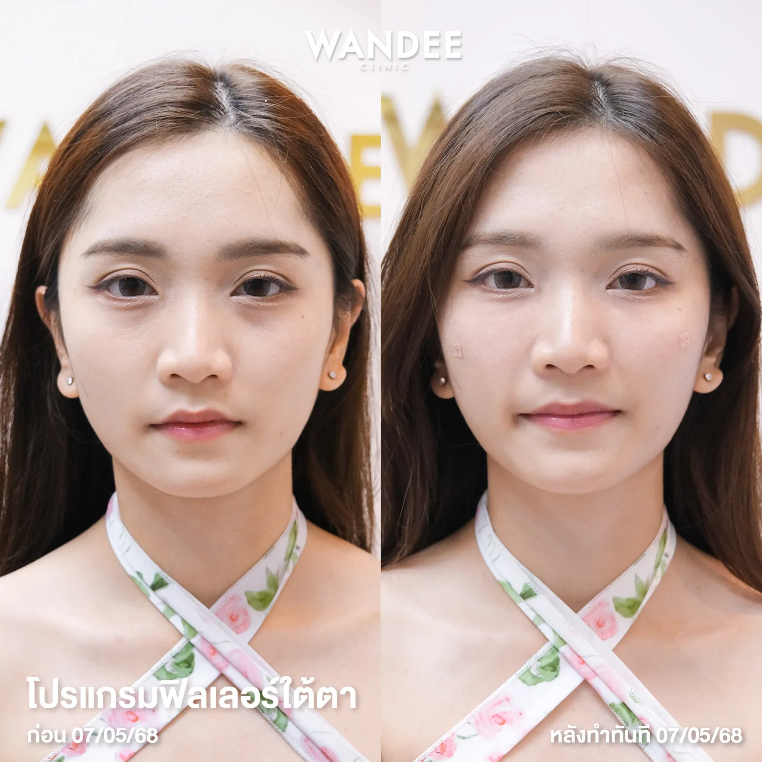 รีวิวเติมฟิลเลอร์ ที่ Wandee Clinic