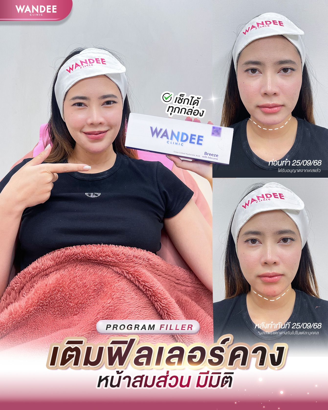 ฟิลเลอร์คาง