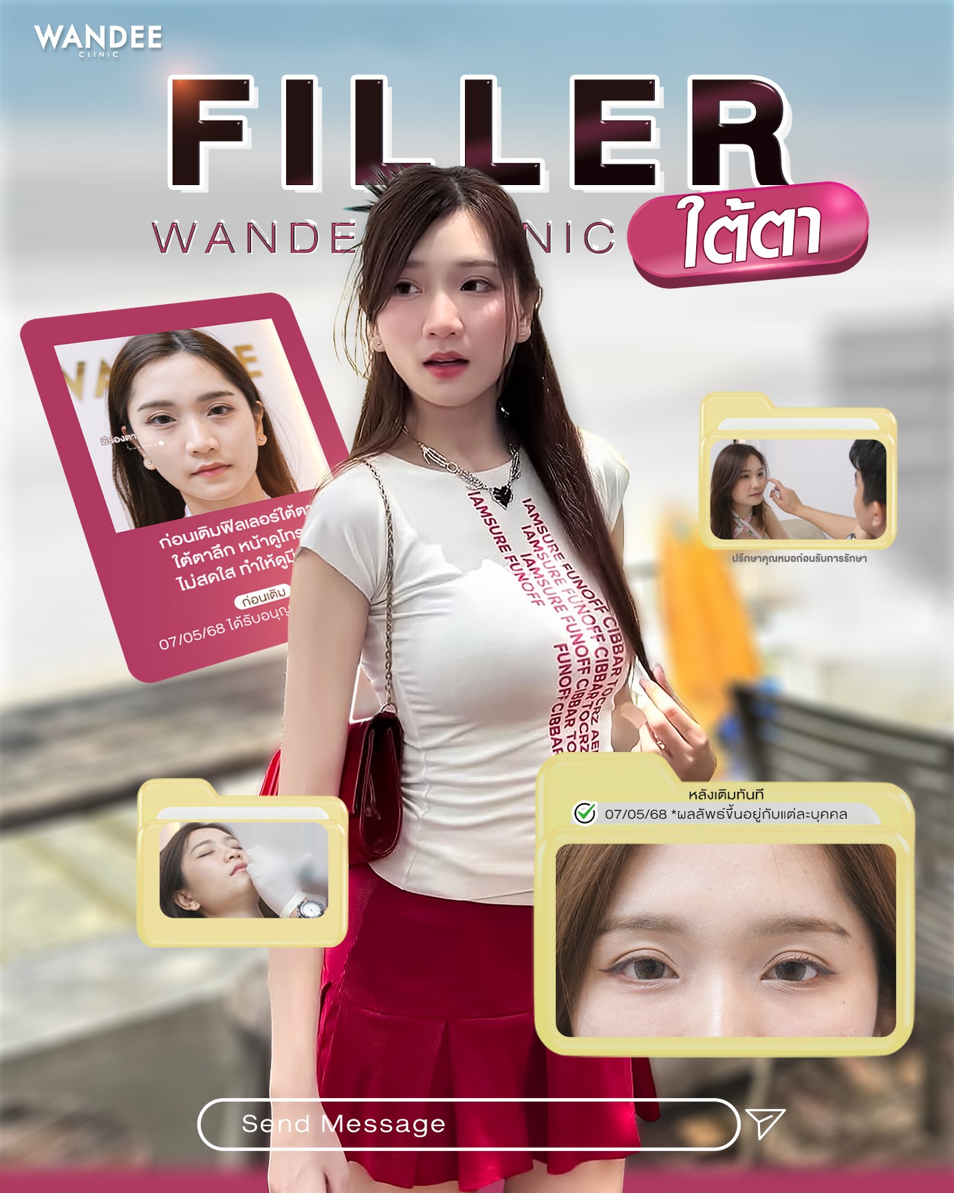 ฟิลเลอร์ใต้ตา