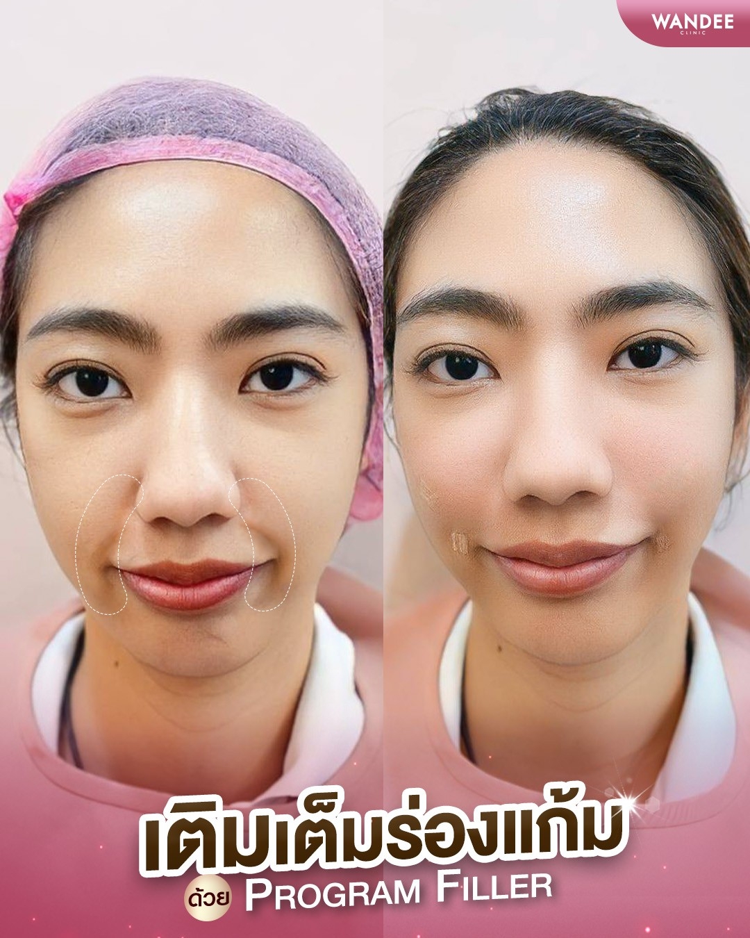 ฟิลเลอร์ร่องแก้ม