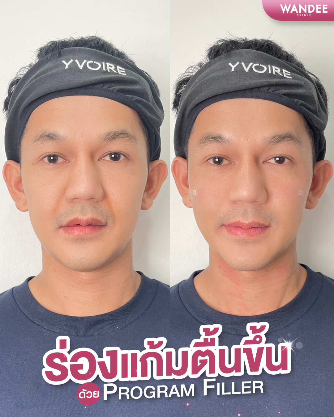 ฟิลเลอร์ร่องแก้ม