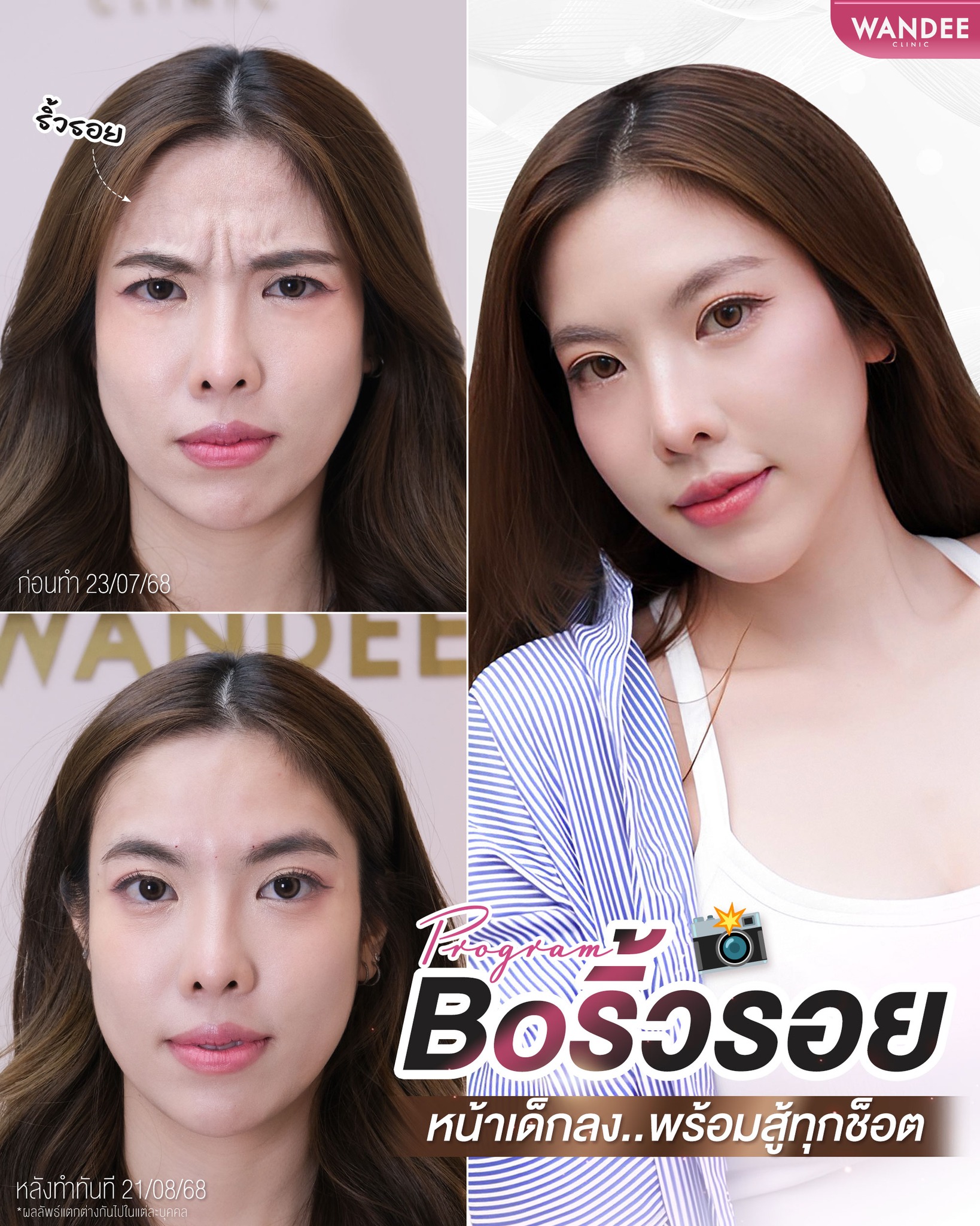 โบท็อกซ์