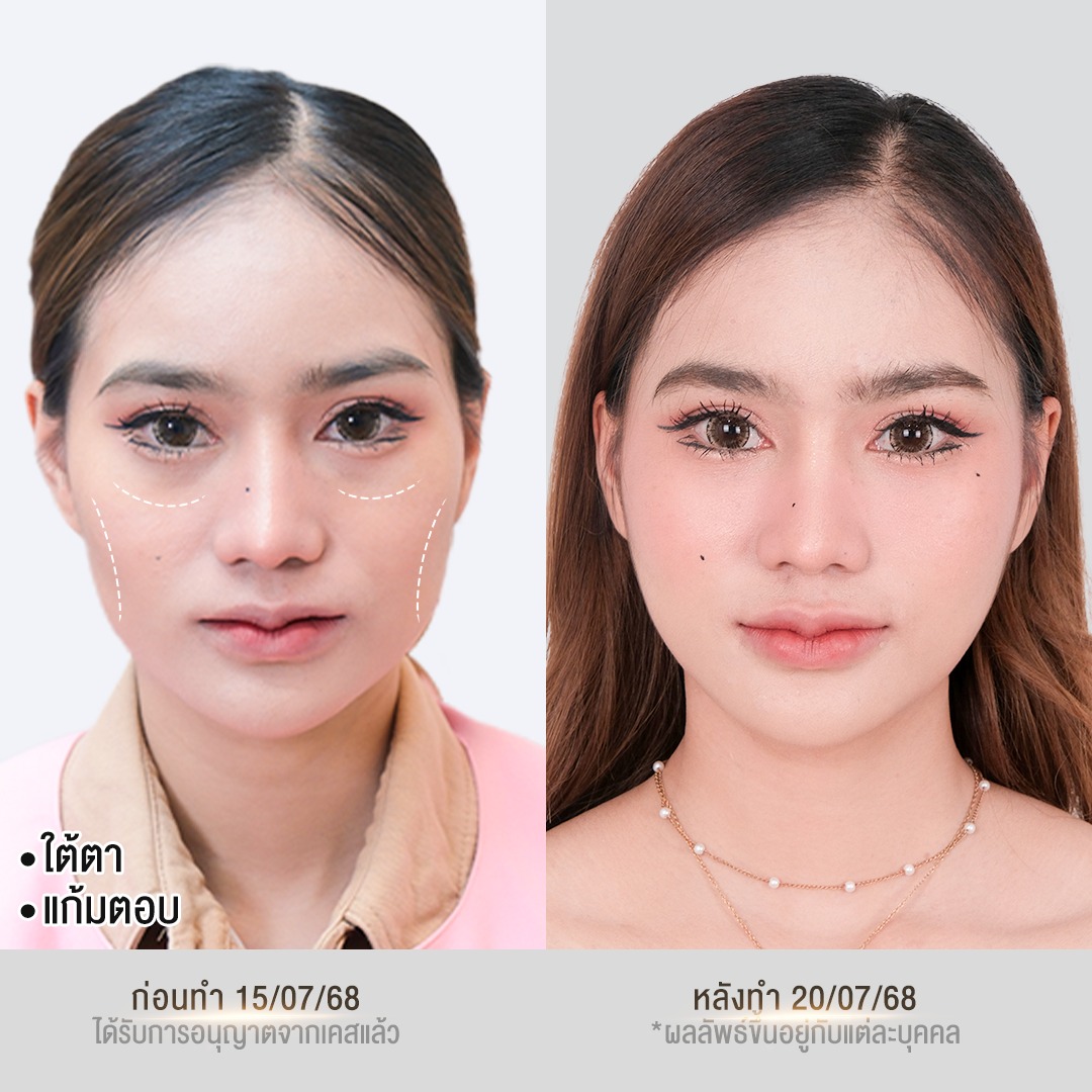 ฟิลเลอร์วันดี