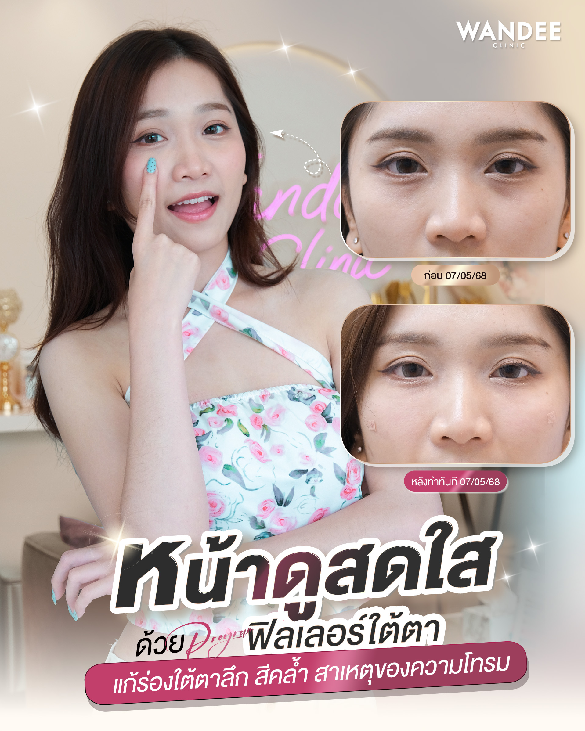 จูเนียร์ ฟิลเลอร์ใต้ตา