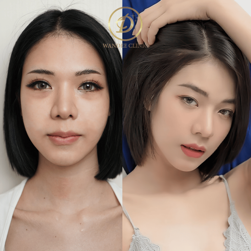 ฟิลเลอร์ใต้ตา-กี้เก้า