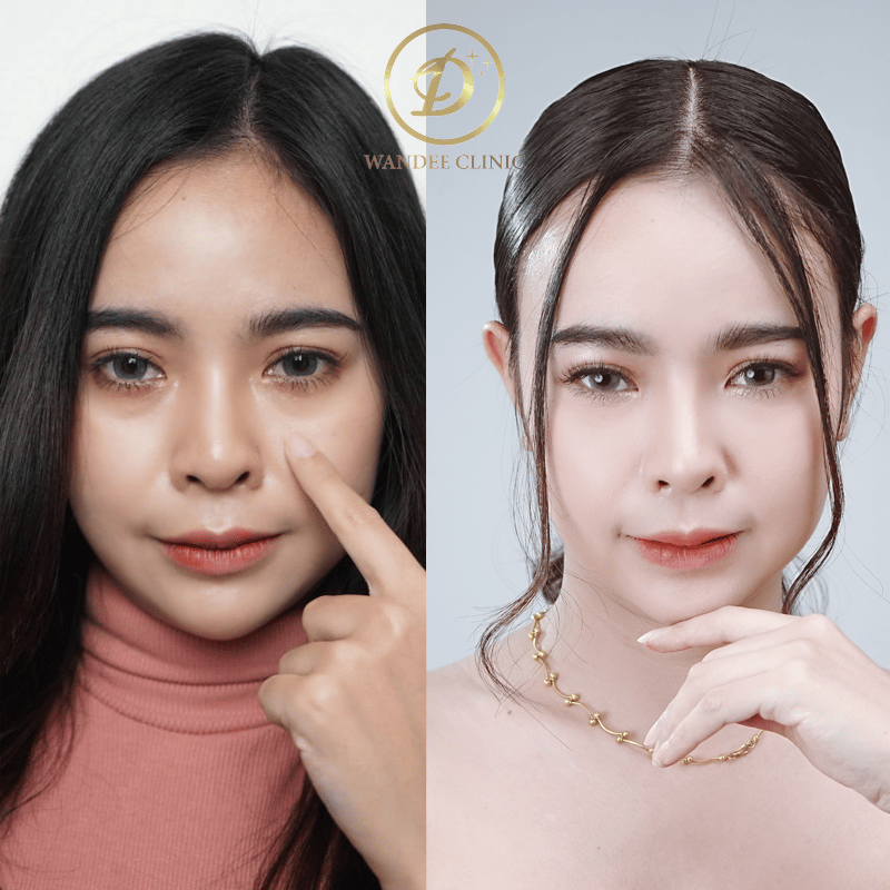 ฟิลเลอร์ใต้ตา-กี้เก้า