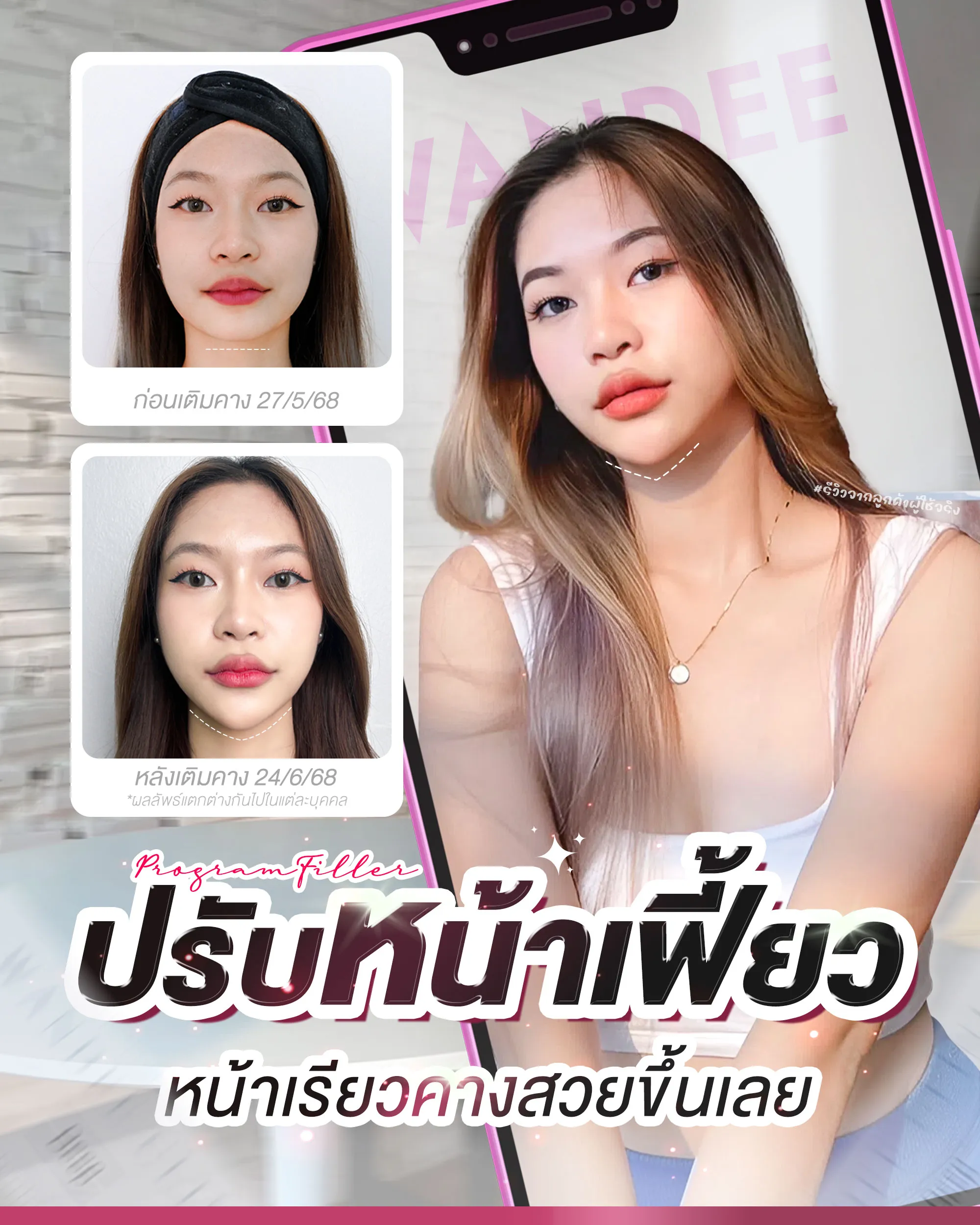 reviwe ฟิลเลอร์คาง Wandee Clinic