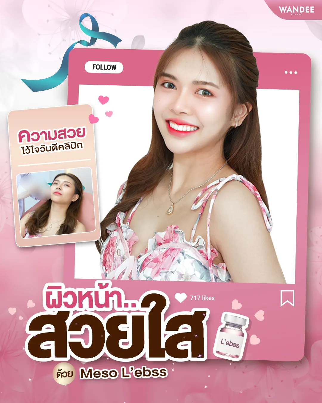 รีวิว เมโสหน้าใส Wandee Clinic