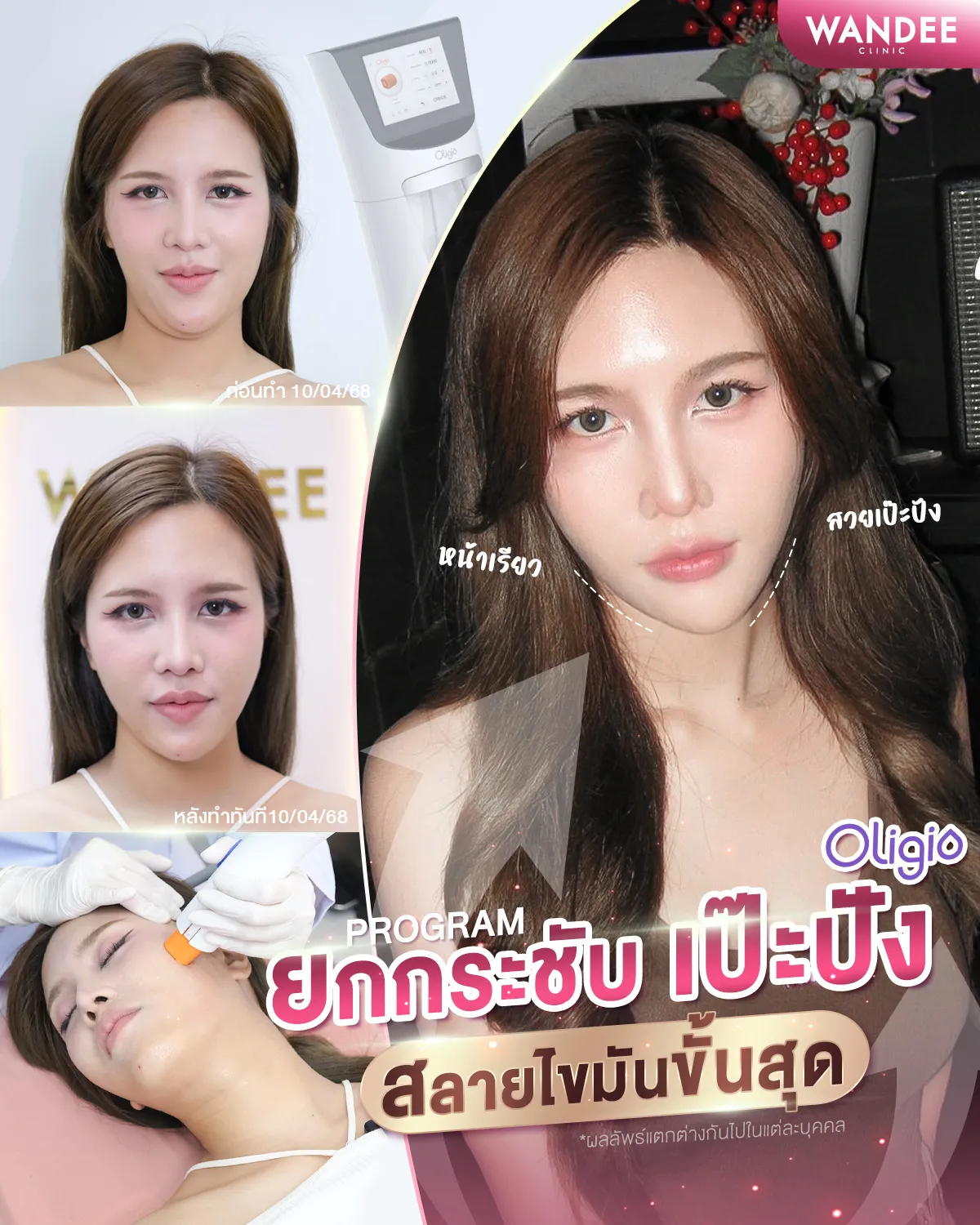 รีวิว oligio Wandee Clinic