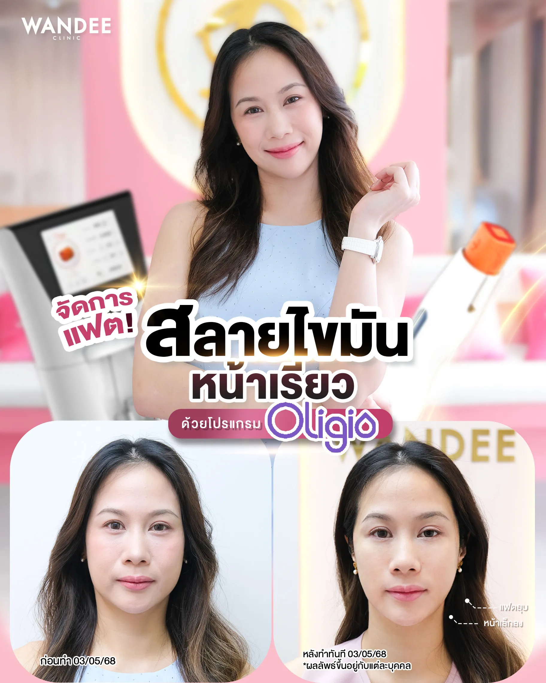 รีวิว oligio Wandee Clinic