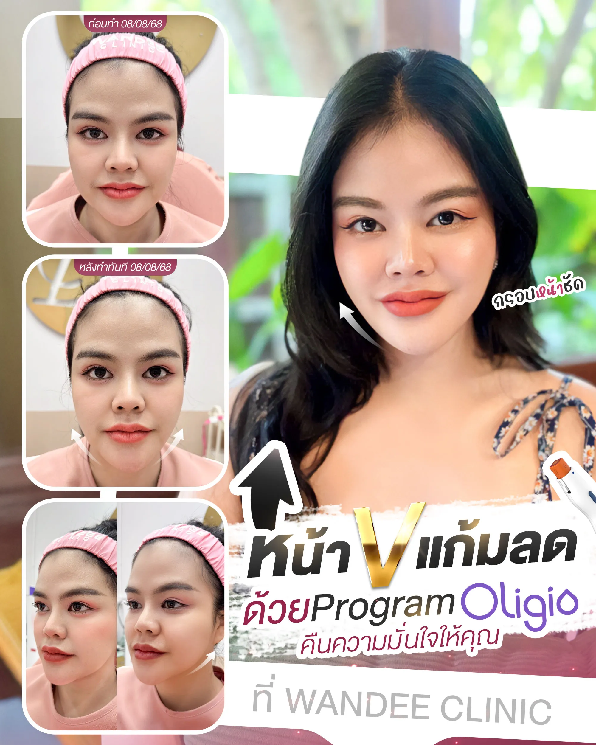 รีวิว oligio Wandee Clinic