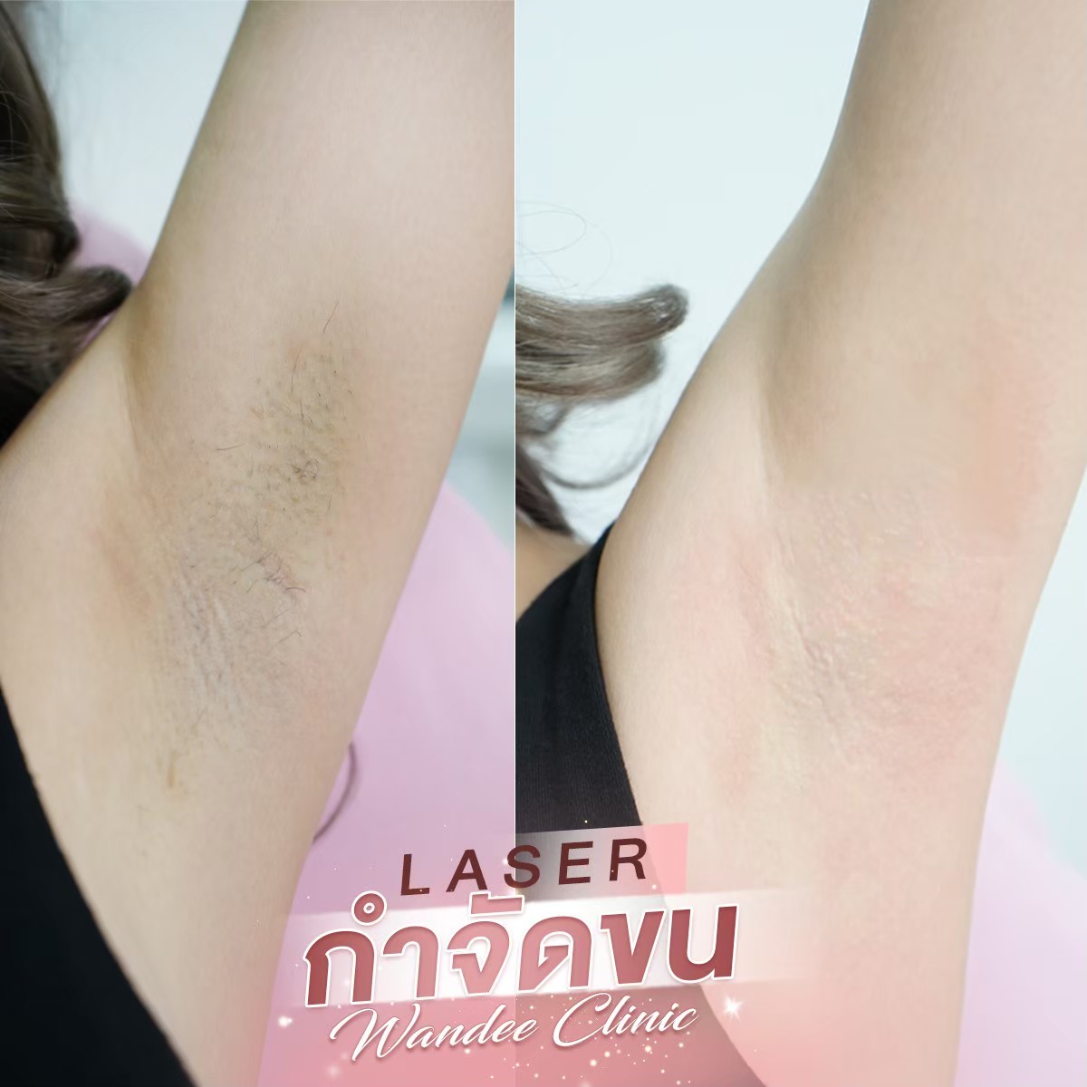 รีวิว laser Wandee Clinic