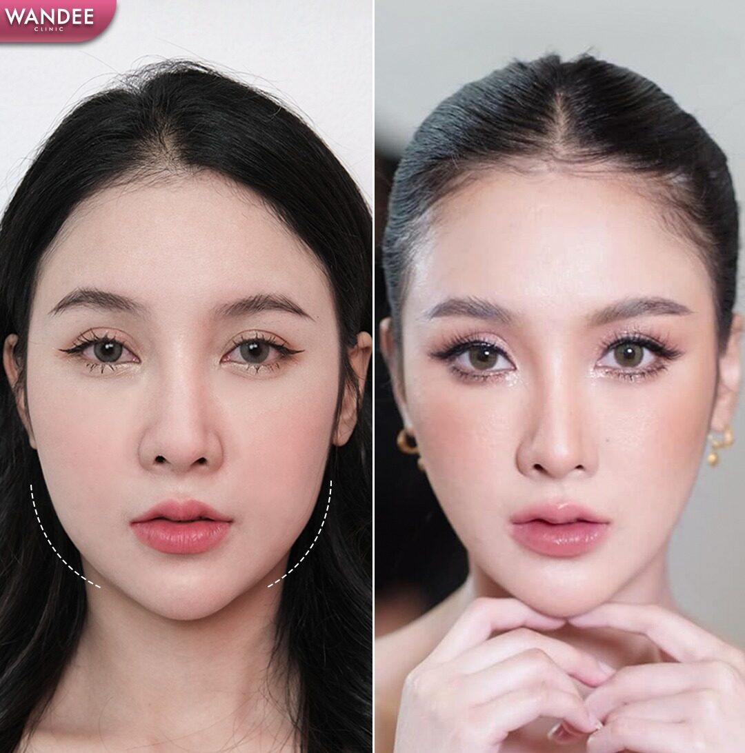 รีวิว โบท็อกซ์ Wandee Clinic