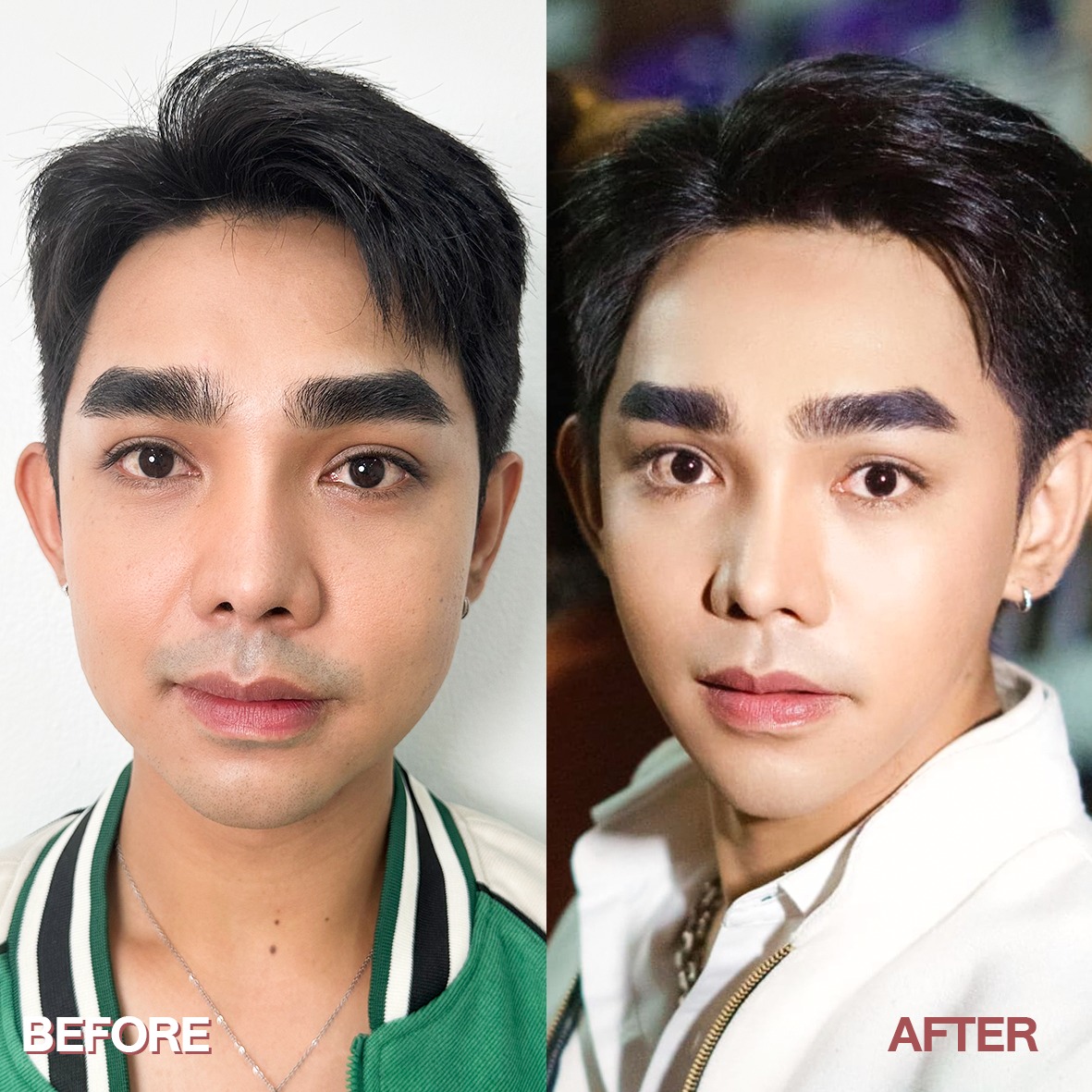 รีวิว โบท็อกซ์ Wandee Clinic