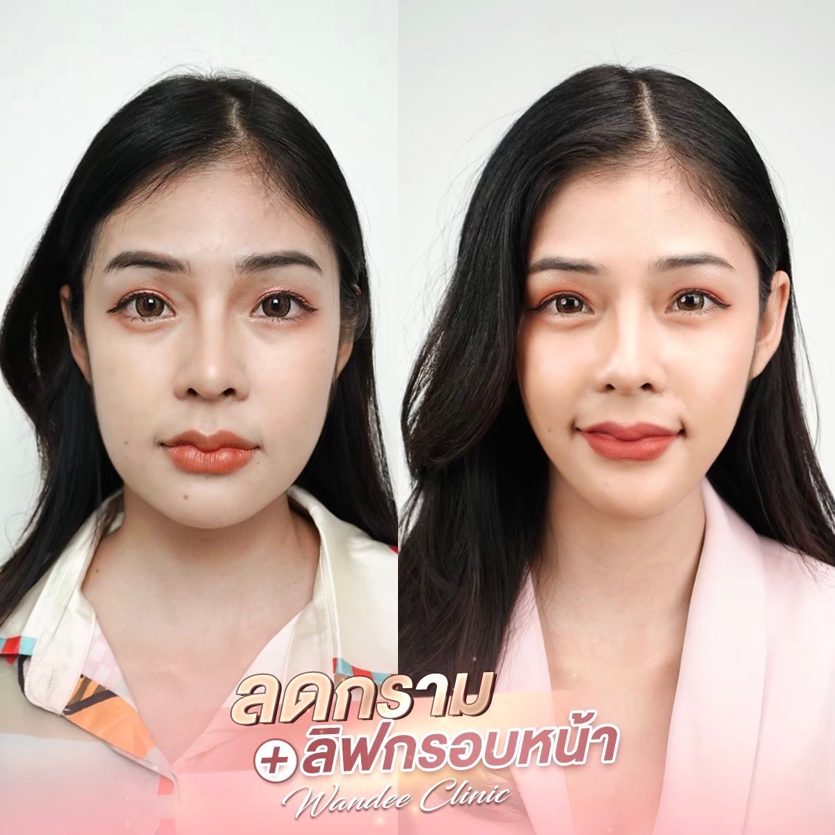 รีวิว โบท็อกซ์ Wandee Clinic รวมลิสต์ แนะนำ 5 คลินิก ฉีดโบท็อกซ์ พัทยา ยอดนิยม